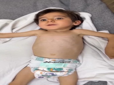 وضعیت وخیم کودک ۴ ساله غزه‌ای به سبب سوء تغذیه شدید