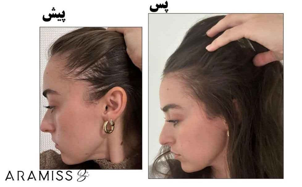 درمان ریزش مو سریع و خانگی